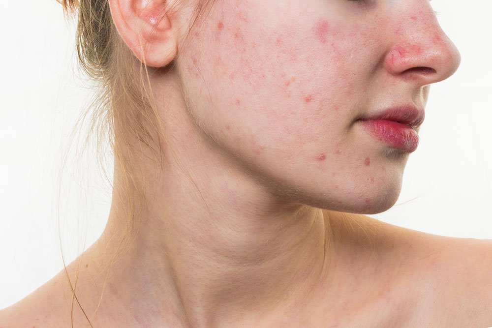 Pesquisa: USP procura voluntários com acne para testar cosméticos
