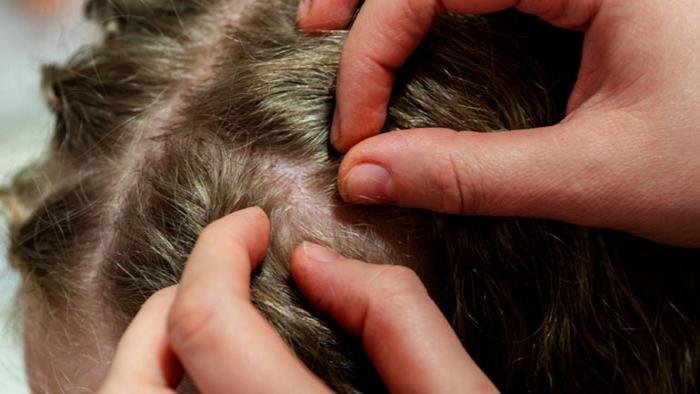 Saúde e Educação farão campanha para prevenção e orientação sobre piolhos