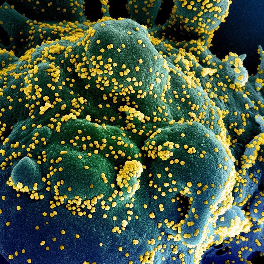 Estudo revela que novo coronavírus também causa morte por insuficiência cardíaca