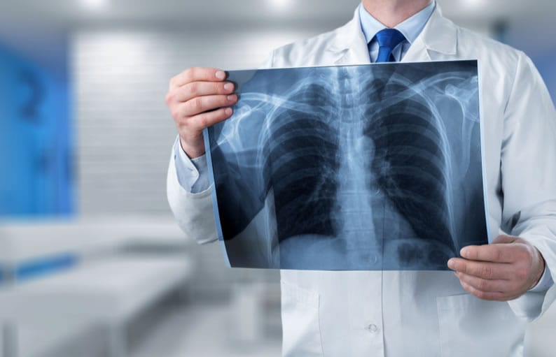 Casos de síndrome respiratória aguda grave caem
