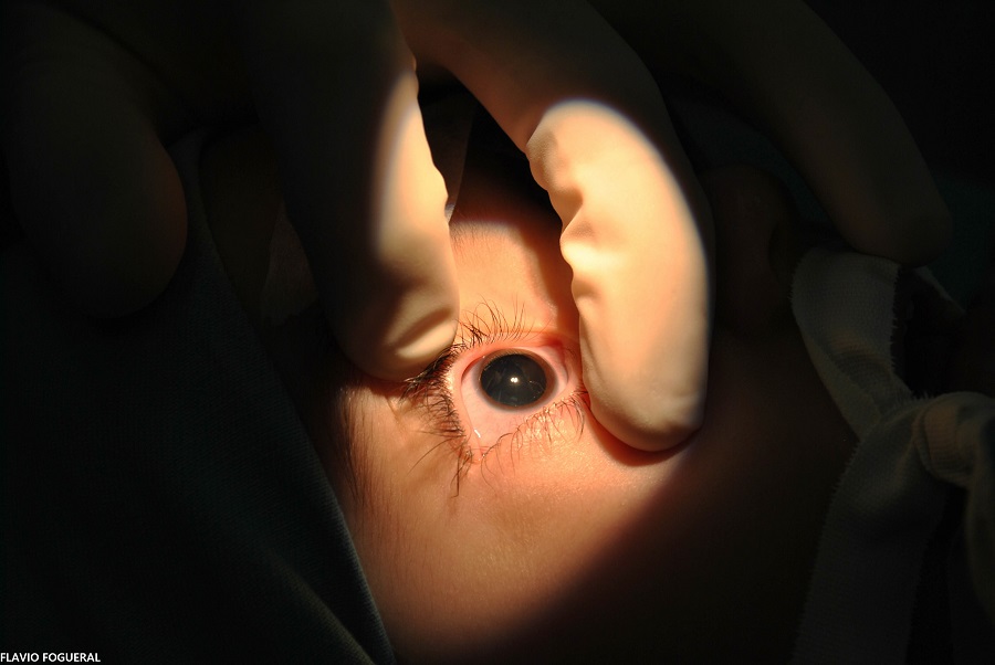 Pandemia faz cair detecção precoce de glaucoma