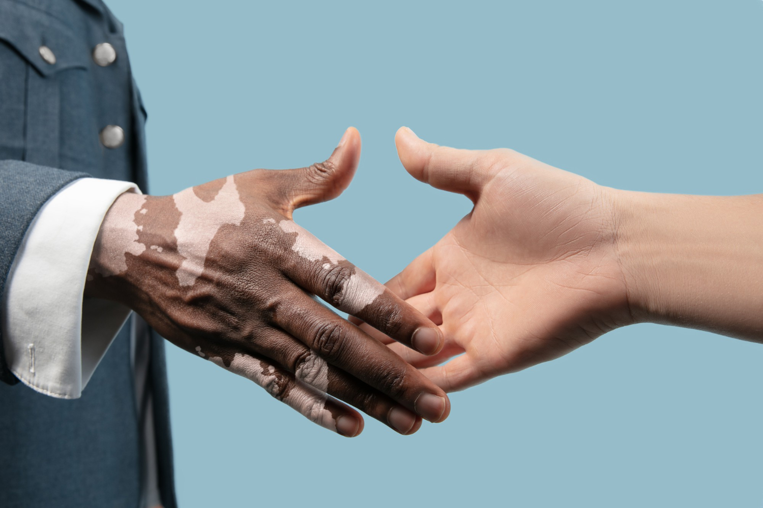 Cerca de 1 milhão de brasileiros sofre de vitiligo, que tem tratamento e cura possível