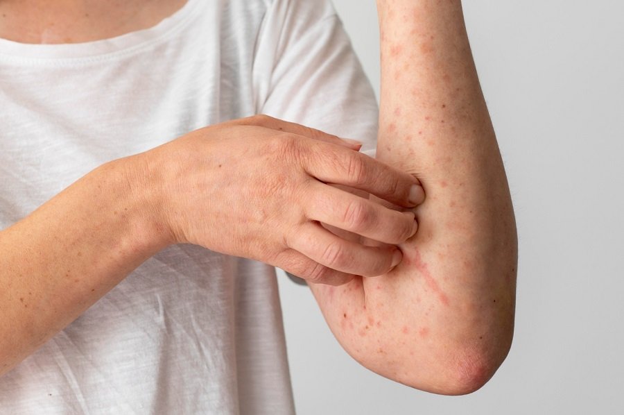 Monkeypox pode causar inflamação no coração?