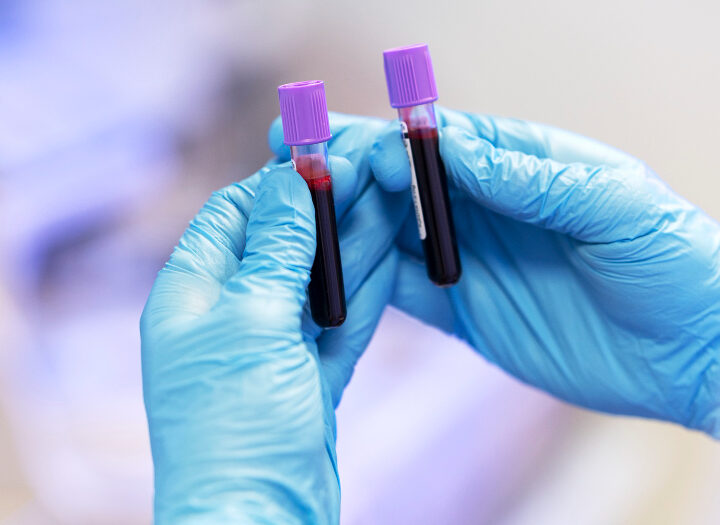Menos conhecidas, hepatites D e E também circulam no Brasil e preocupam