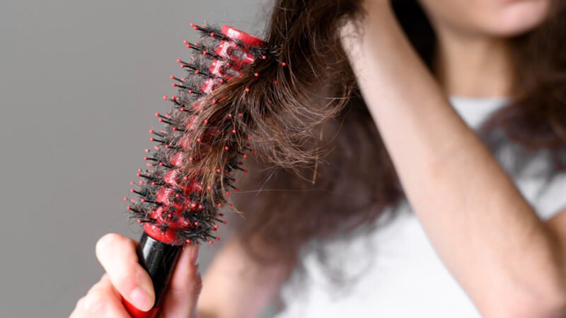 Impacto mental da alopecia areata é maior do que a gravidade da doença