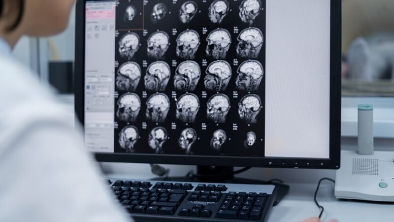 Marca-passo neural reduz sintomas da depressão resistente