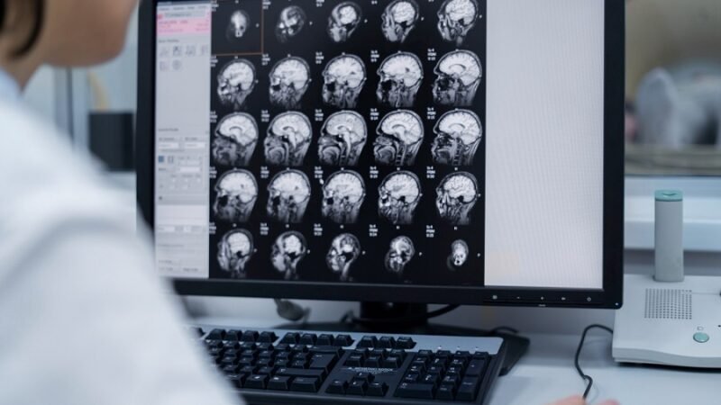 Avanços permitem diagnosticar esclerose múltipla antes dos sintomas